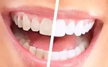 如何判断自己是否需要去洗牙了呢？